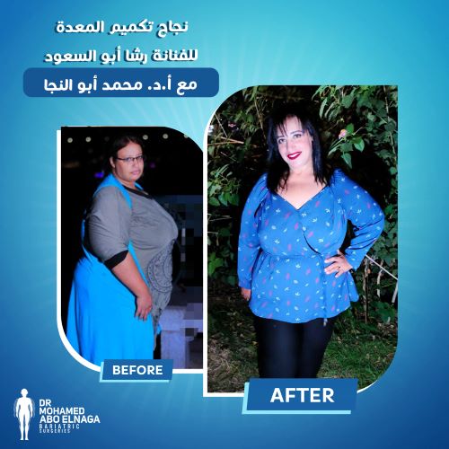 النظام الغذائي بعد عملية التكميم